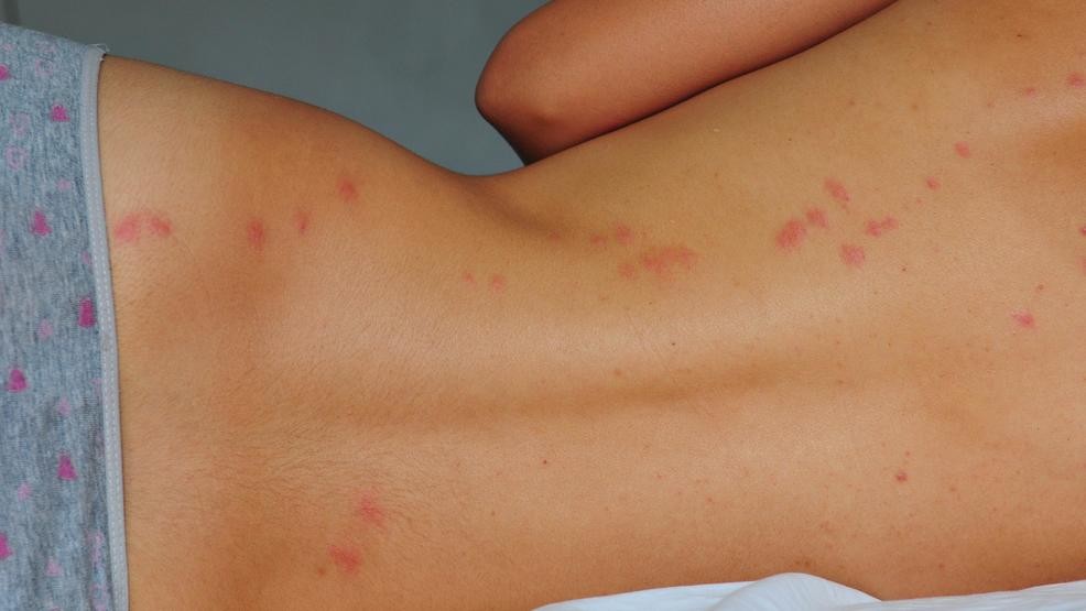 Bed bug bites are the primary effects of bed bugs on human health.
