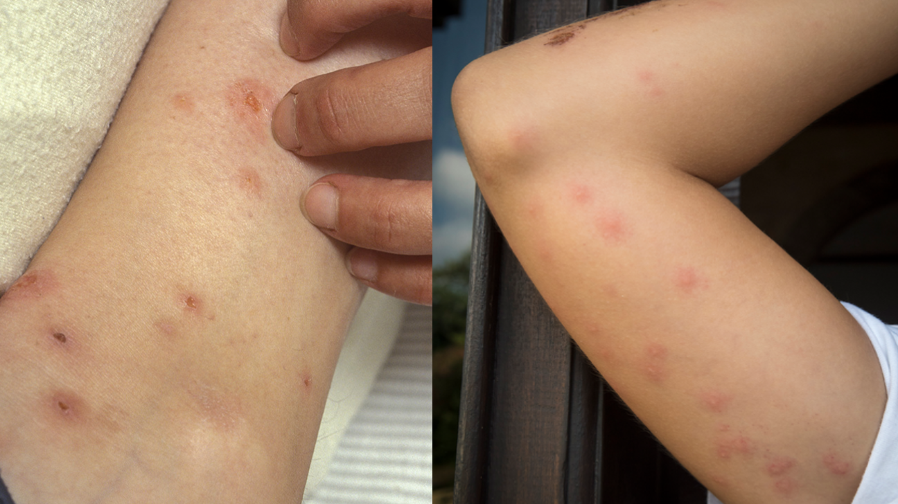 Flea Bites Vs Bed Bugs Pictures Best Hotel Bed