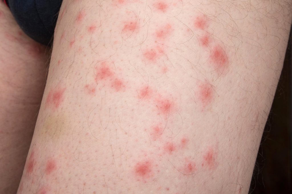 Bed bug bites can be very itchy.