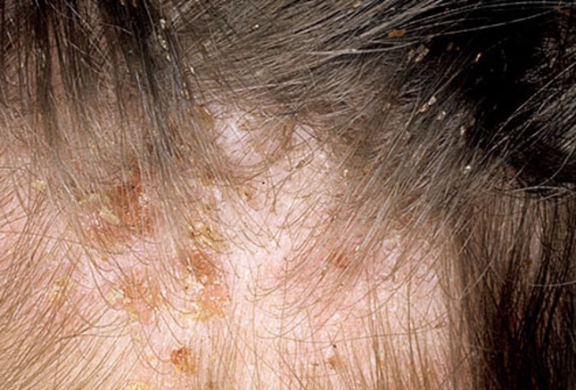 Head lice can itch because of scalp dryness.